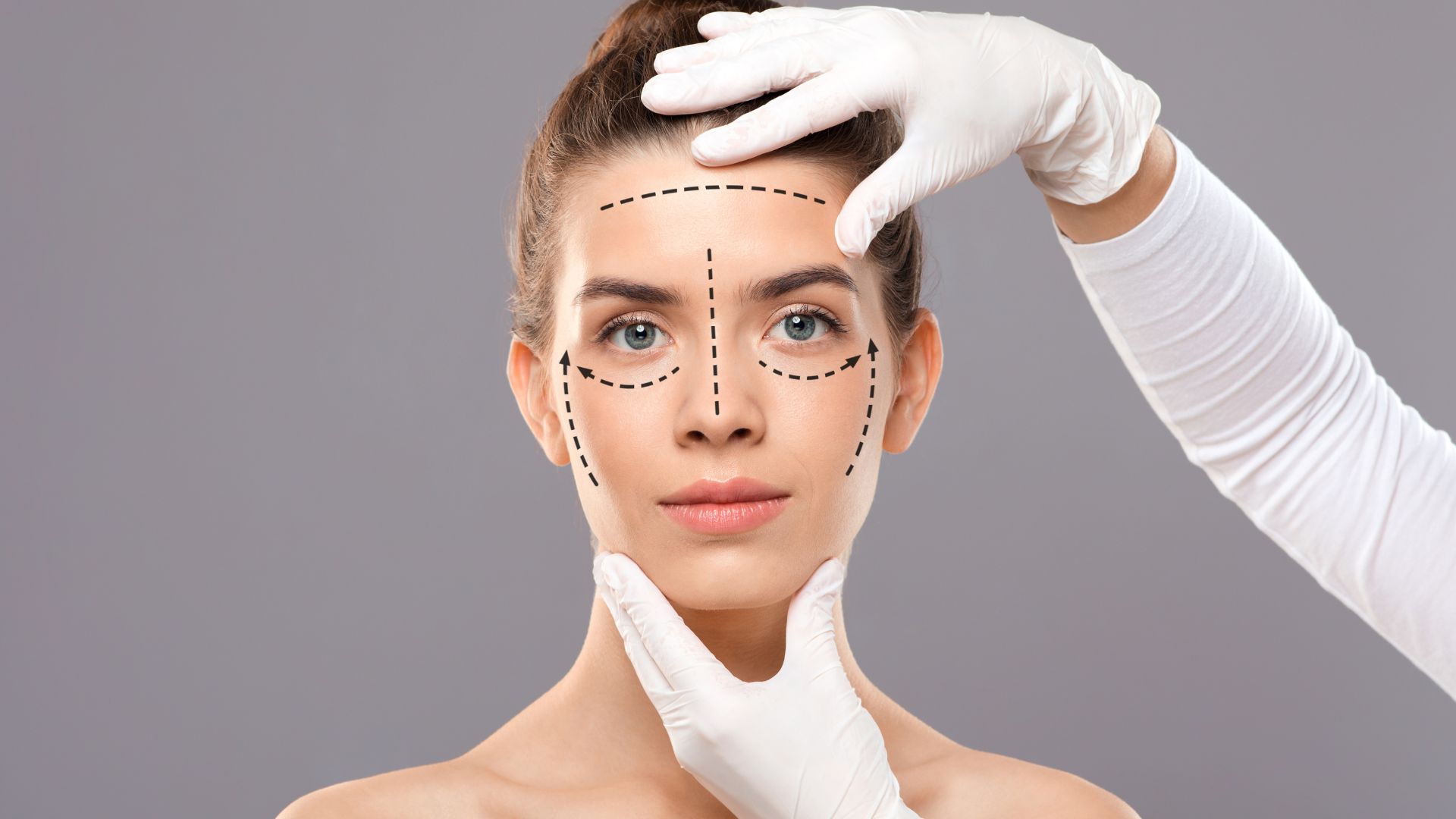 Ellansé Faltenunterspritzung in Meerbusch – Filler mit Kollagenstimulation für natürliche Ergebnisse